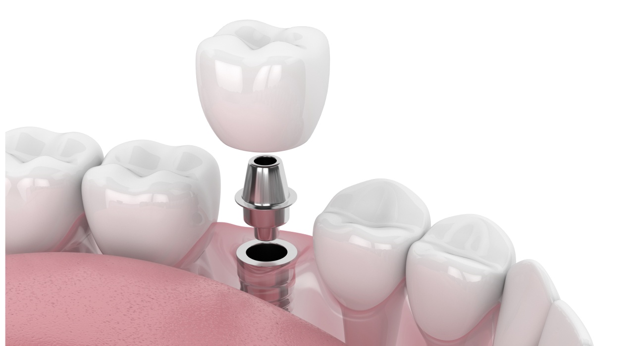 Single Dental Implants West Chester, Ohio